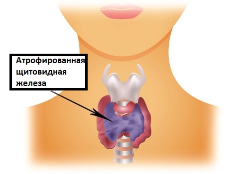Гипотиреоз