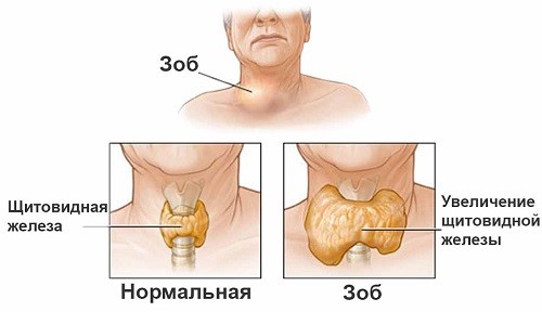 Зоб: диффузный и узловой
